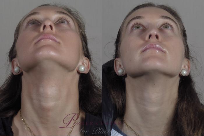 Rhinoplasty Case 1373 Before & After worns | Paramus, NJ | Parker Center for Plastic Surgery