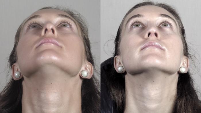 Rhinoplasty Case 1373 Before & After Worn's View | Paramus, New Jersey | Parker Center for Plastic Surgery