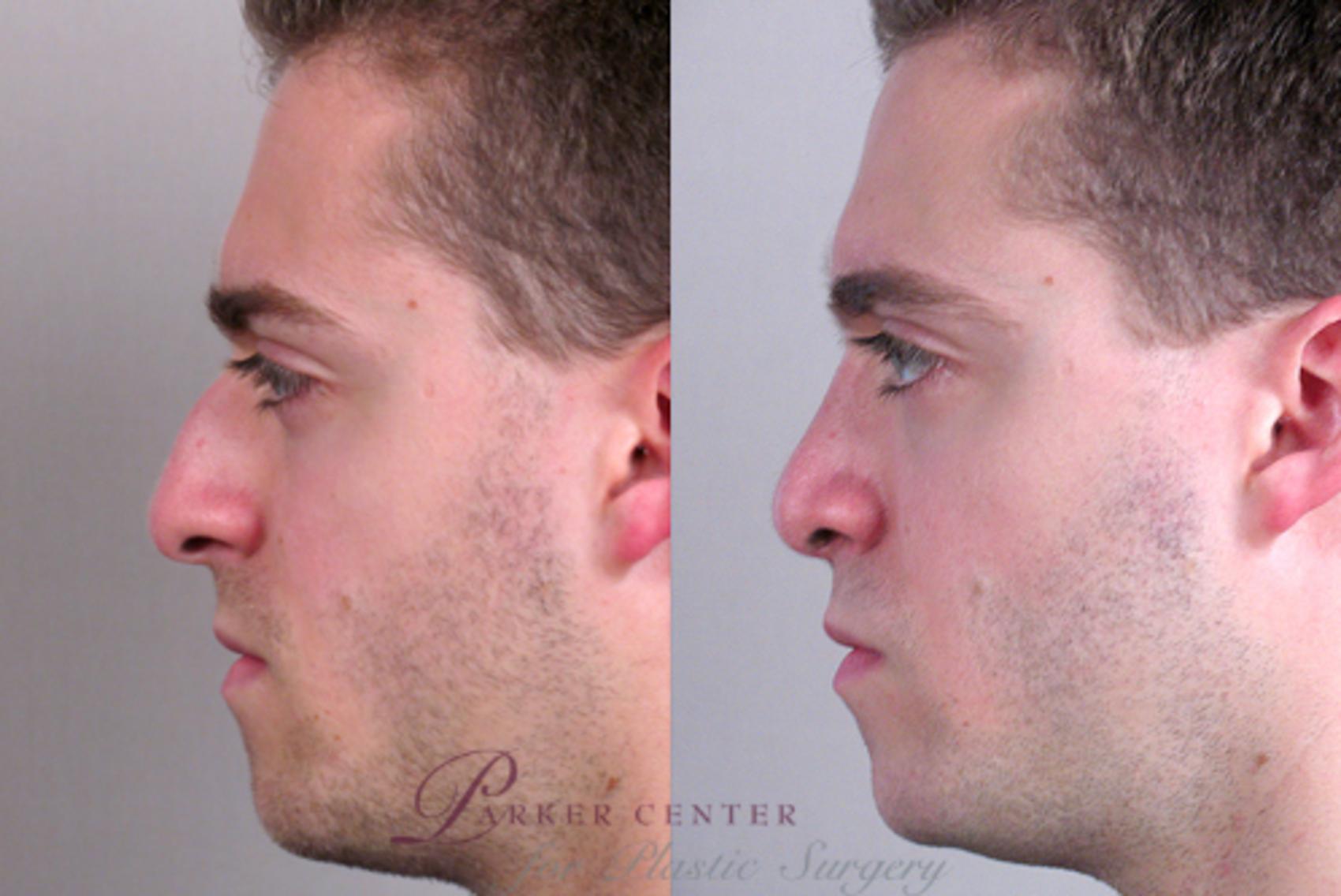 Rhinoplasty Case 138 Before & After View #2 | Paramus, NJ | Parker Center for Plastic Surgery