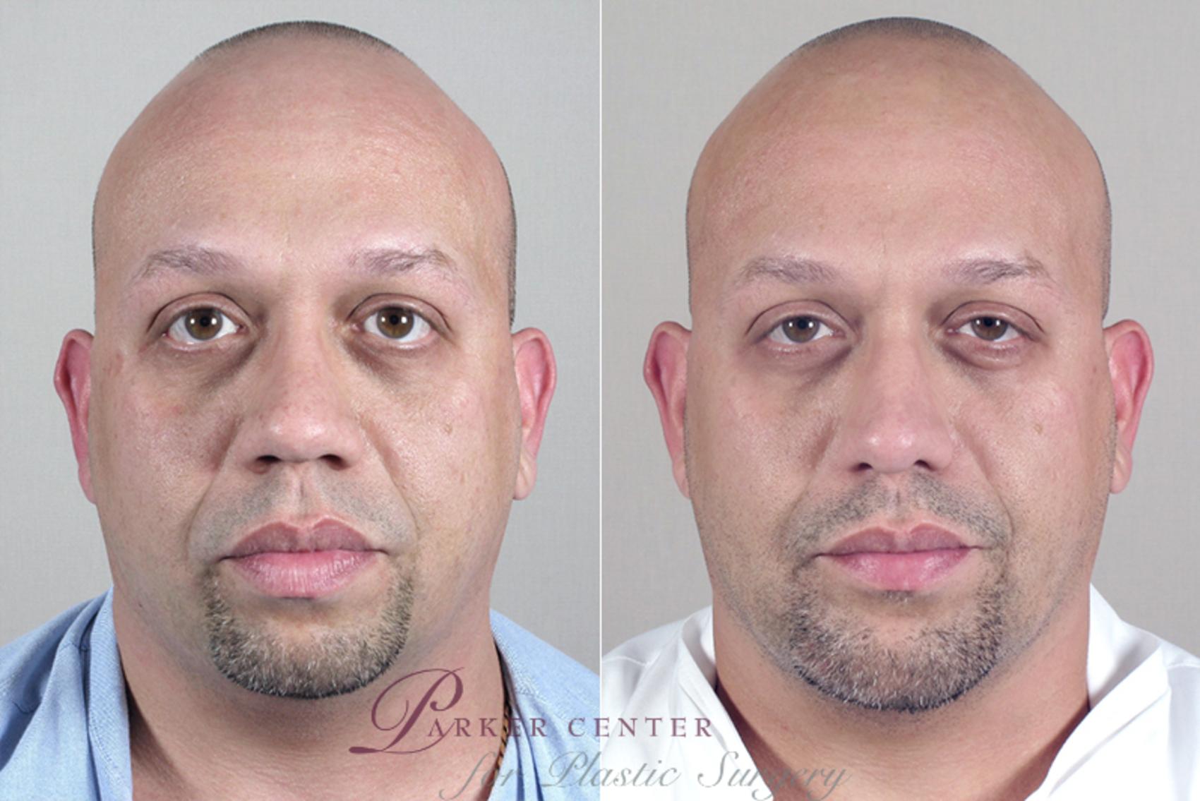 Cheek/Chin Implants Case 139 Before & After View #1 | Paramus, NJ | Parker Center for Plastic Surgery