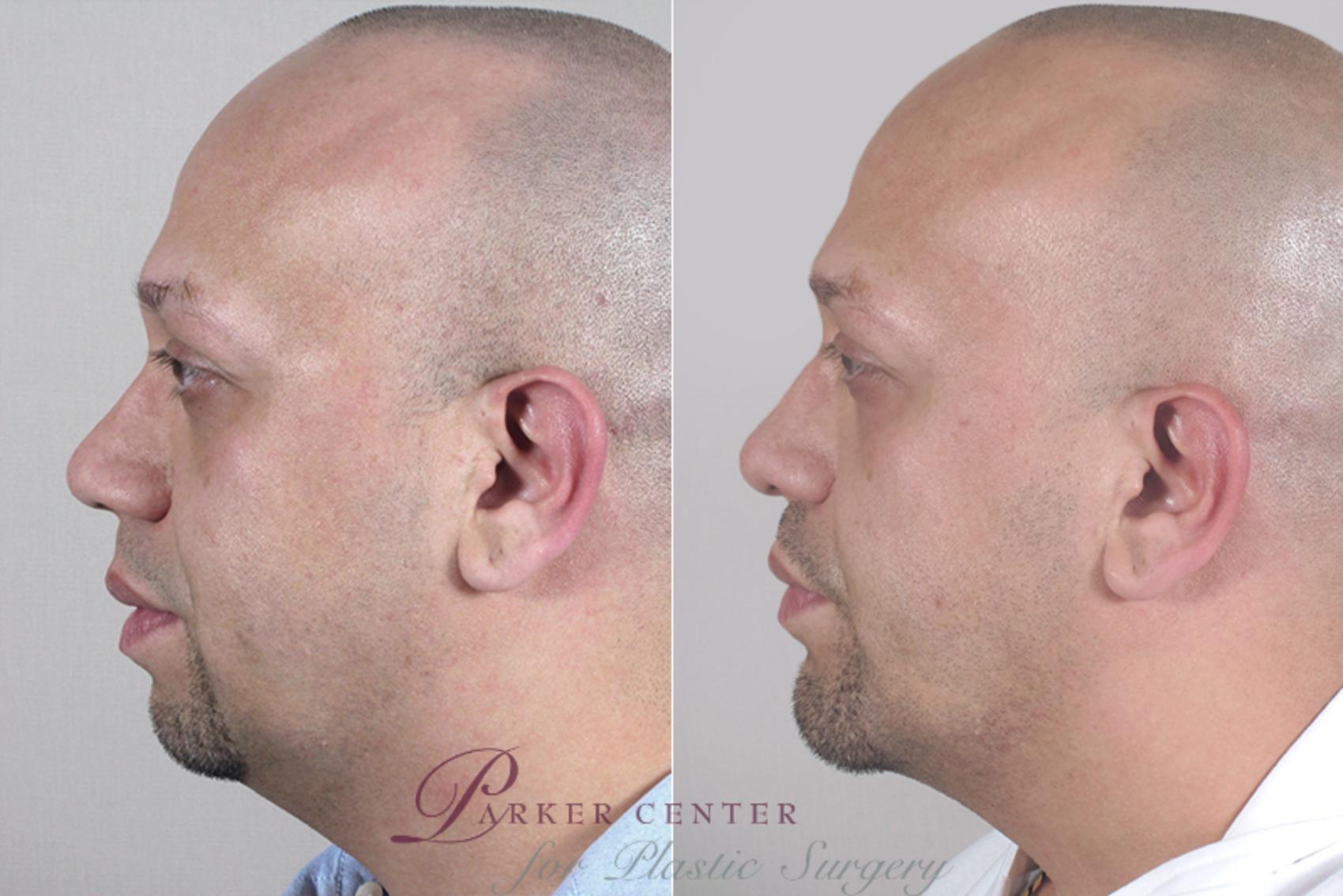 Rhinoplasty Case 139 Before & After View #2 | Paramus, NJ | Parker Center for Plastic Surgery
