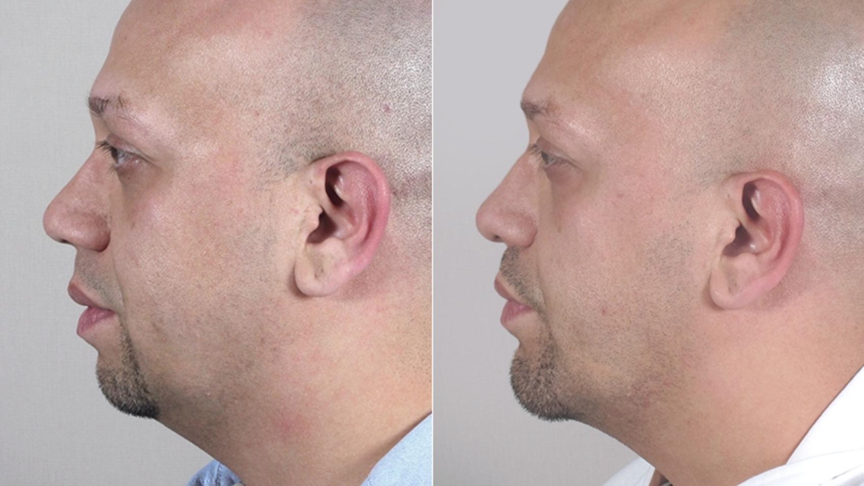 Rhinoplasty Case 139 Before & After View #2 | Paramus, New Jersey | Parker Center for Plastic Surgery