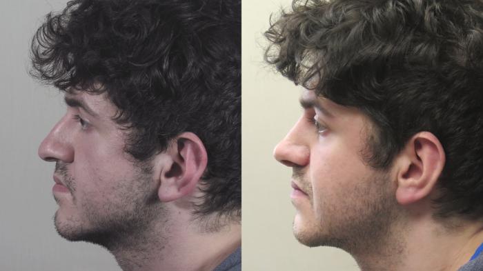 Rhinoplasty Case 1397 Before & After Left Side | Paramus, New Jersey | Parker Center for Plastic Surgery