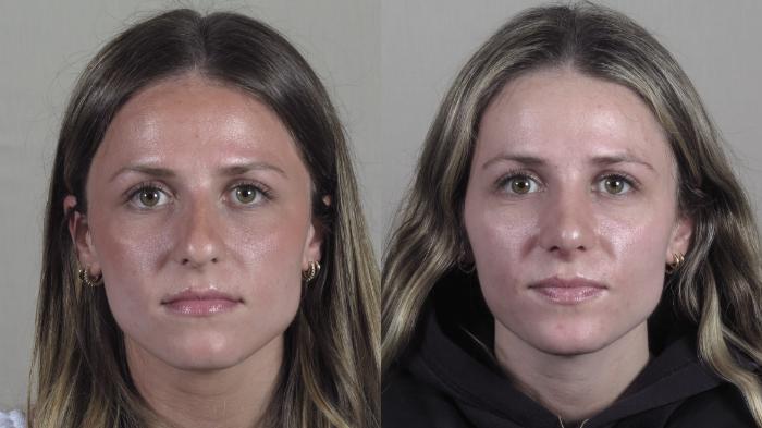 Rhinoplasty Case 1399 Before & After Front | Paramus, New Jersey | Parker Center for Plastic Surgery