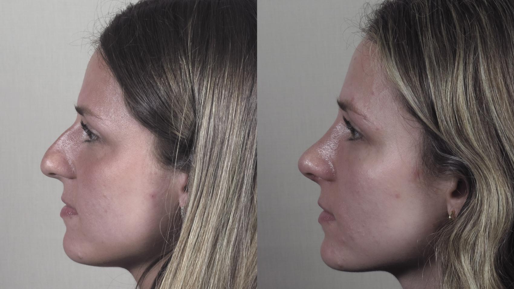 Rhinoplasty Case 1399 Before & After Left Side | Paramus, New Jersey | Parker Center for Plastic Surgery