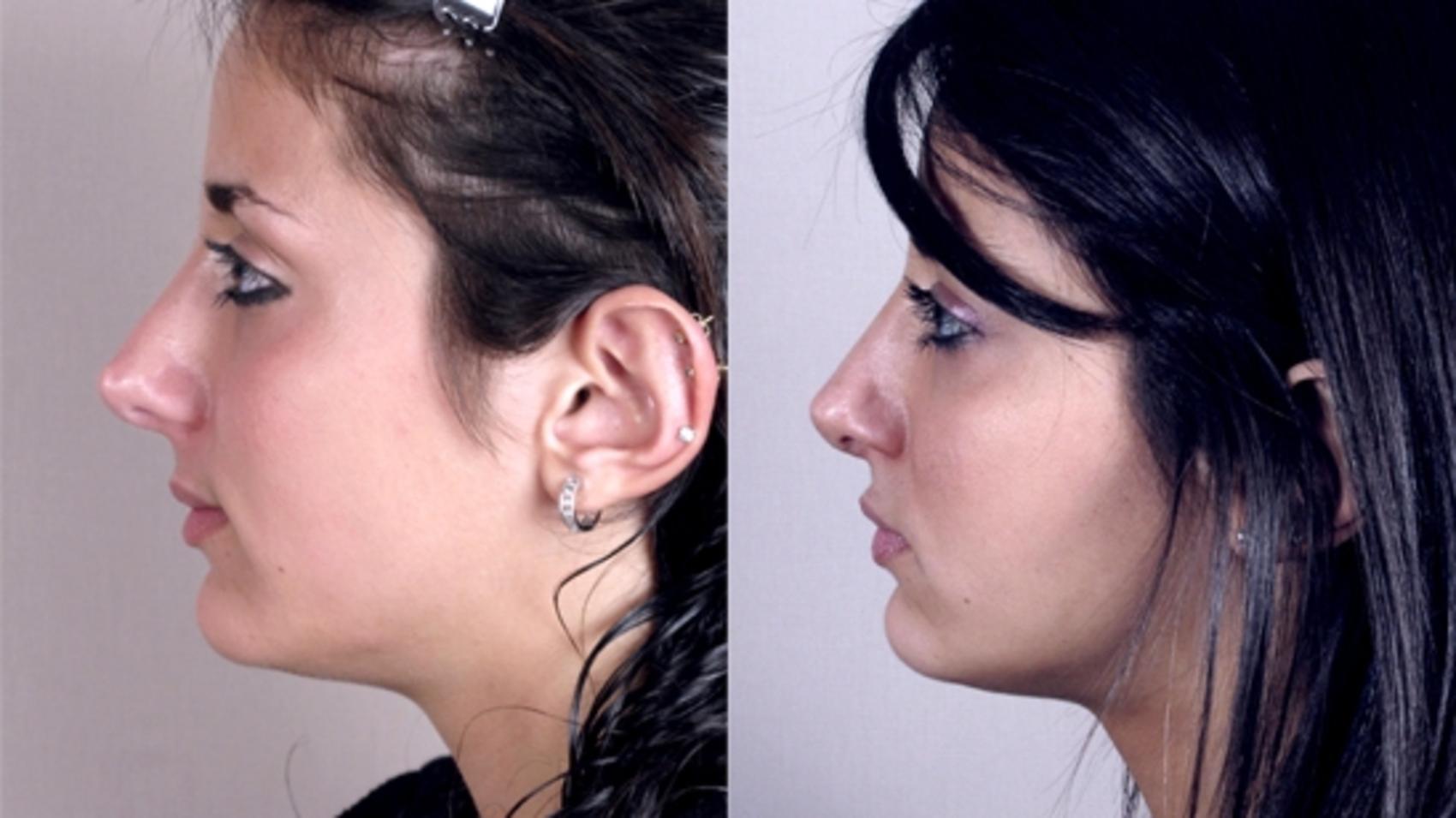 Rhinoplasty Case 140 Before & After View #2 | Paramus, NJ | Parker Center for Plastic Surgery