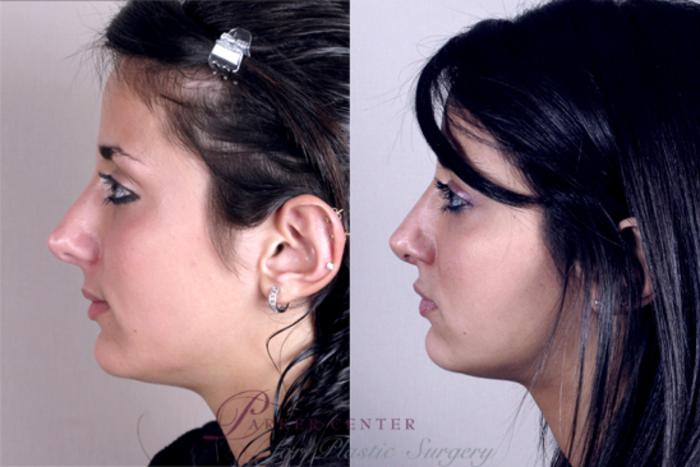 Rhinoplasty Case 140 Before & After View #2 | Paramus, NJ | Parker Center for Plastic Surgery