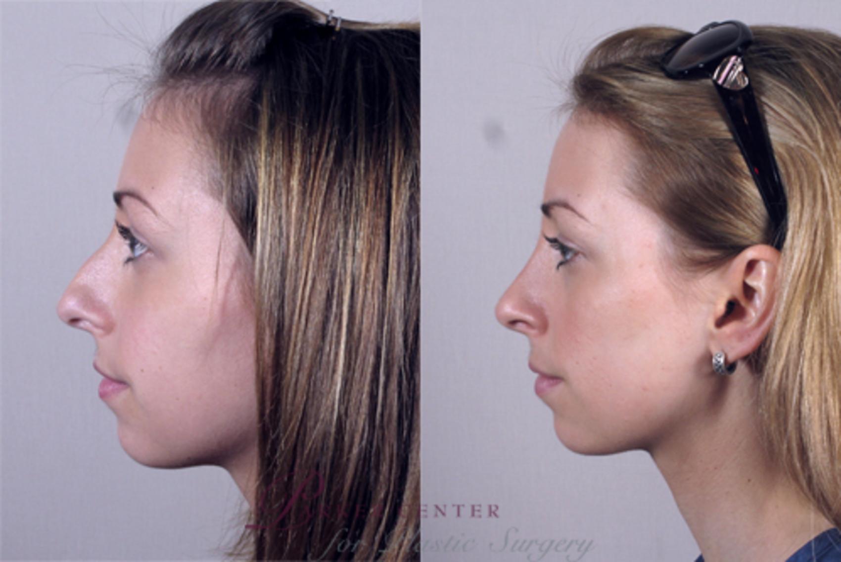 Rhinoplasty Case 141 Before & After View #2 | Paramus, NJ | Parker Center for Plastic Surgery