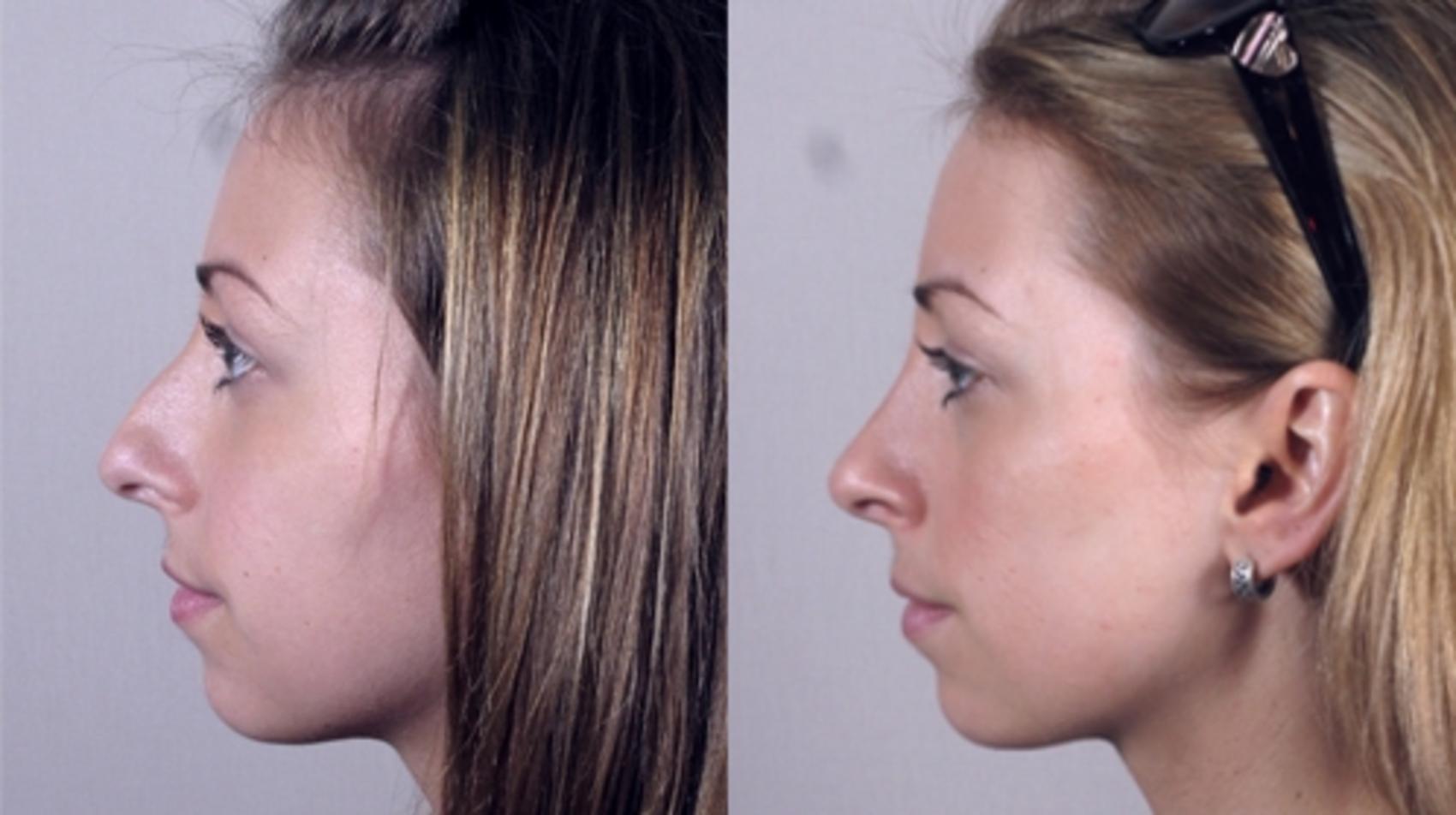 Rhinoplasty Case 141 Before & After View #2 | Paramus, NJ | Parker Center for Plastic Surgery