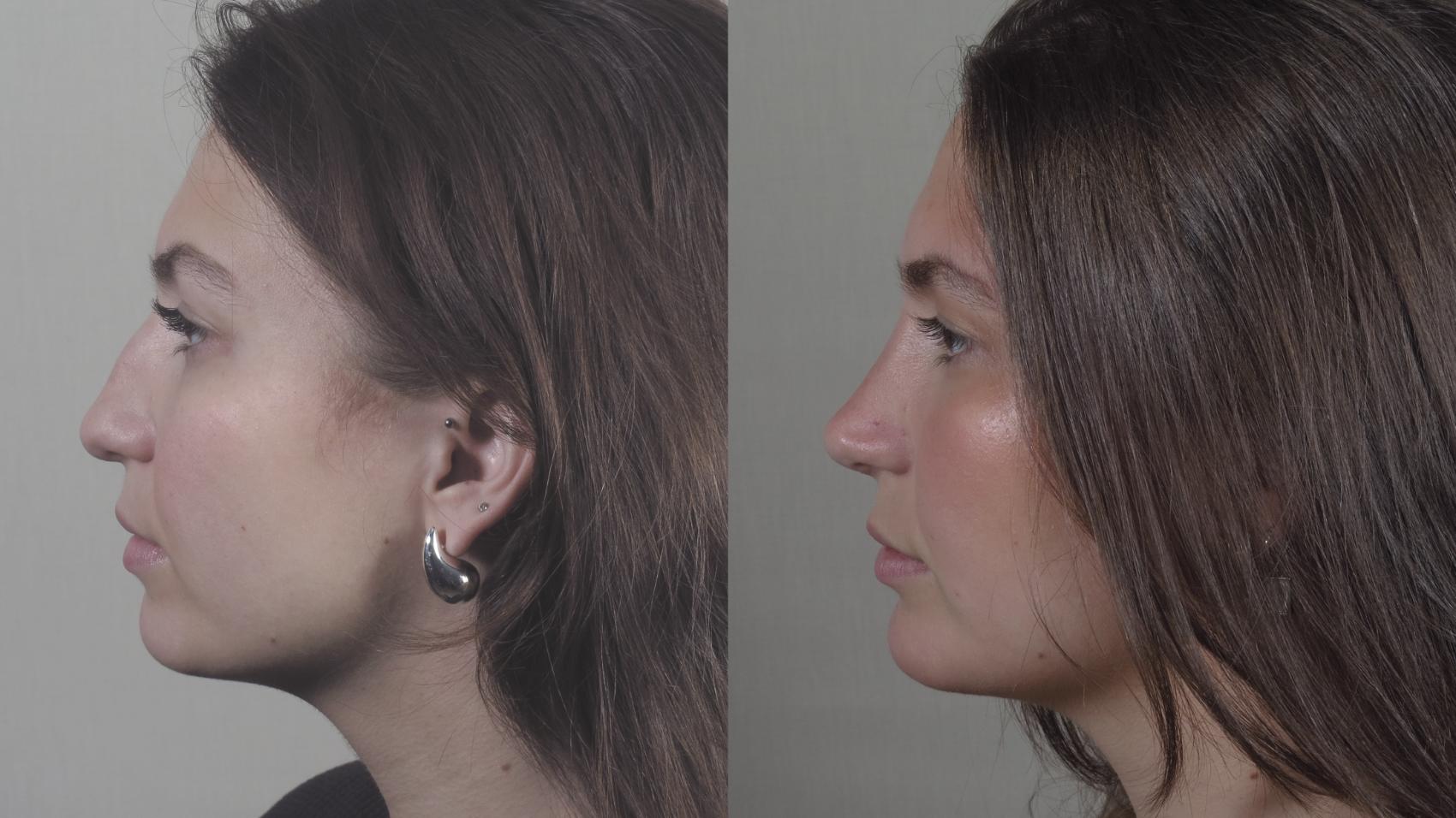 Rhinoplasty Case 1416 Before & After Side view | Paramus, New Jersey | Parker Center for Plastic Surgery