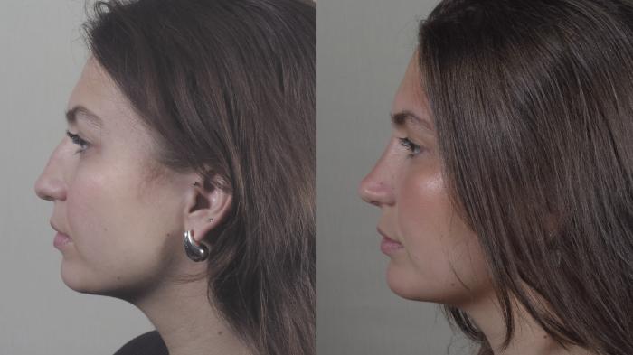 Chin Implants Case 1416 Before & After Side view | Paramus, New Jersey | Parker Center for Plastic Surgery