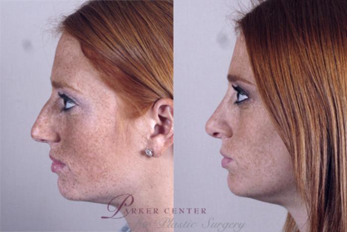 Rhinoplasty Case 142 Before & After View #2 | Paramus, NJ | Parker Center for Plastic Surgery