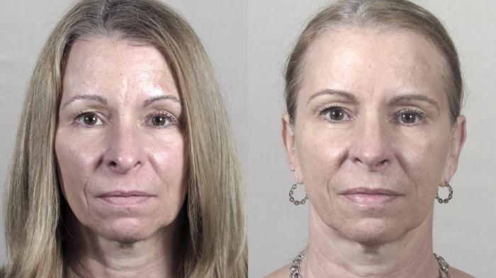 Chin Implants Case 1424 Before & After Front | Paramus, New Jersey | Parker Center for Plastic Surgery