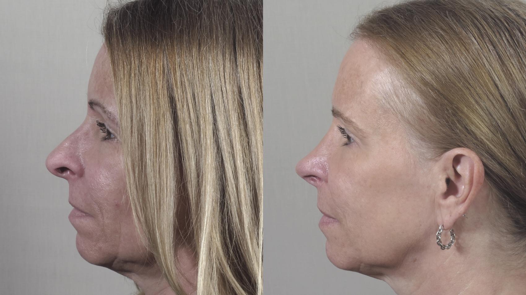 Rhinoplasty Case 1424 Before & After Side view | Paramus, New Jersey | Parker Center for Plastic Surgery