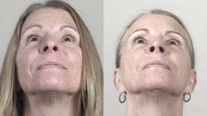 Chin Implants Case 1424 Before & After Worn's View | Paramus, New Jersey | Parker Center for Plastic Surgery