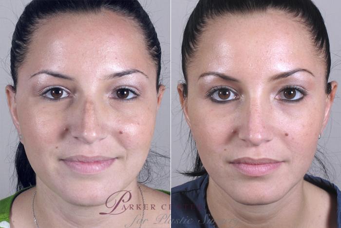 Rhinoplasty Case 143 Before & After View #1 | Paramus, NJ | Parker Center for Plastic Surgery