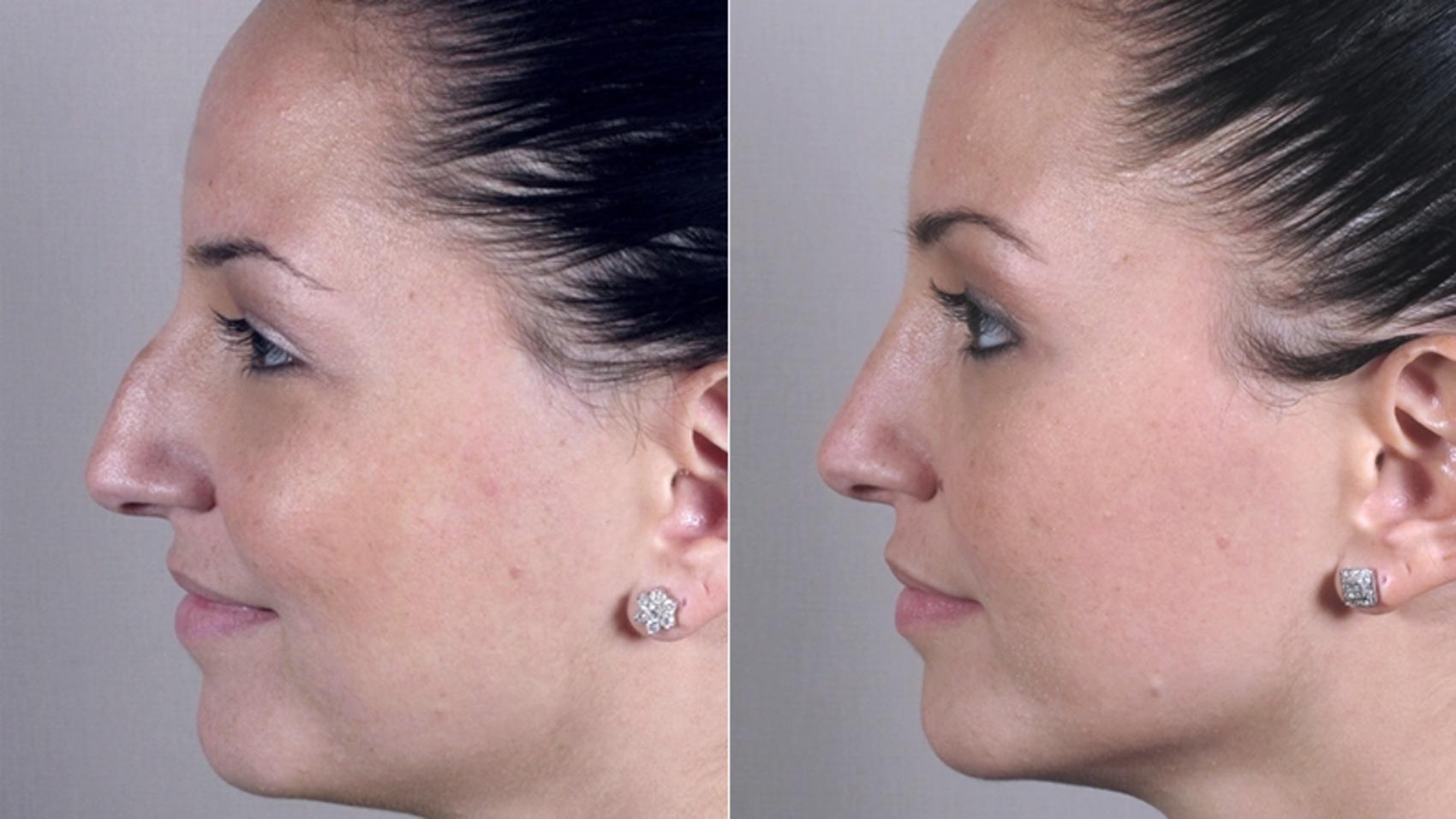 Rhinoplasty Case 143 Before & After View #2 | Paramus, New Jersey | Parker Center for Plastic Surgery