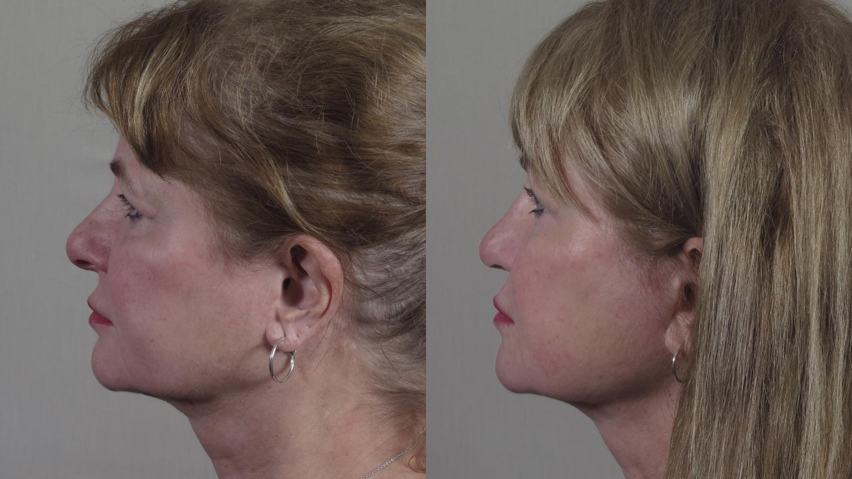 Rhinoplasty Case 1430 Before & After Side profile | Paramus, New Jersey | Parker Center for Plastic Surgery