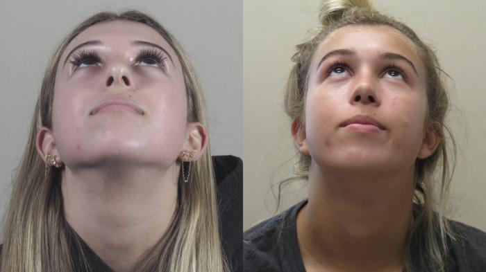 Rhinoplasty Case 1431 Before & After Looking up | Paramus, New Jersey | Parker Center for Plastic Surgery