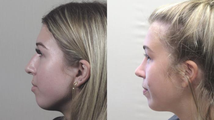 Rhinoplasty Case 1431 Before & After Profile view | Paramus, New Jersey | Parker Center for Plastic Surgery