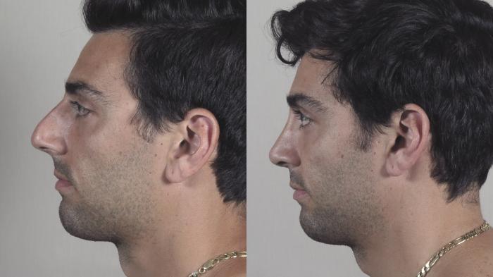 Rhinoplasty Case 1433 Before & After Left Side | Paramus, New Jersey | Parker Center for Plastic Surgery