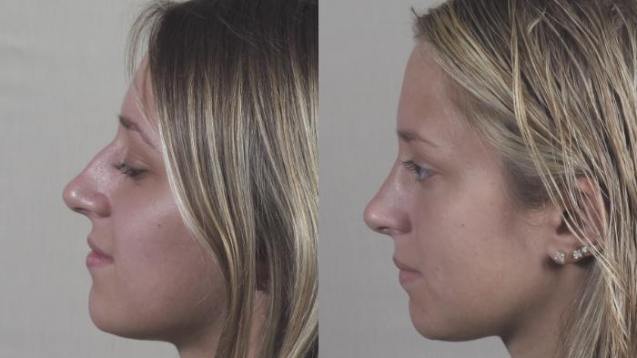 Rhinoplasty Case 1437 Before & After Left Side | Paramus, New Jersey | Parker Center for Plastic Surgery