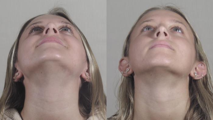 Rhinoplasty Case 1437 Before & After Worm's | Paramus, New Jersey | Parker Center for Plastic Surgery