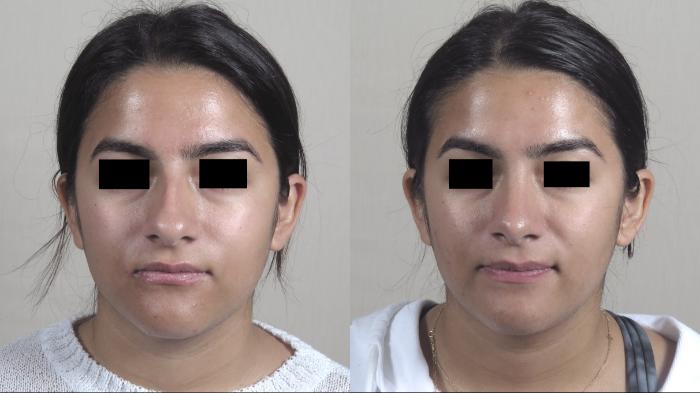 Rhinoplasty Case 1441 Before & After Front | Paramus, New Jersey | Parker Center for Plastic Surgery