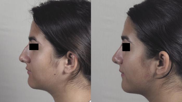 Rhinoplasty Case 1441 Before & After Left Side | Paramus, New Jersey | Parker Center for Plastic Surgery