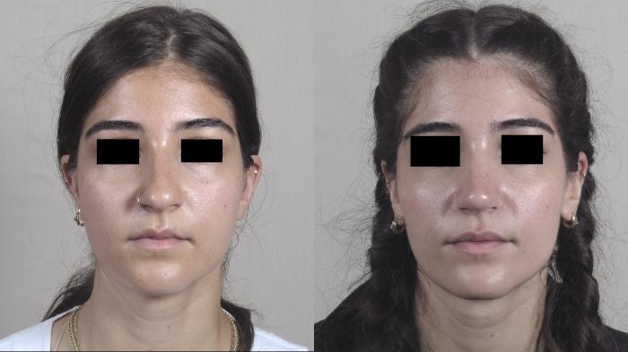 Rhinoplasty Case 1444 Before & After Front | Paramus, New Jersey | Parker Center for Plastic Surgery