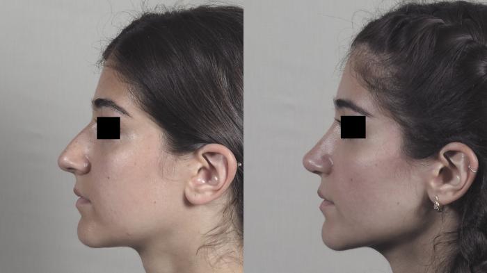 Rhinoplasty Case 1444 Before & After Left Side | Paramus, New Jersey | Parker Center for Plastic Surgery