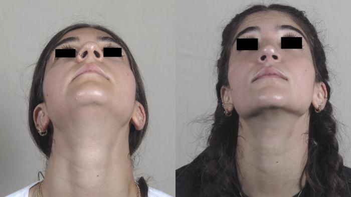 Rhinoplasty Case 1444 Before & After Worm's | Paramus, New Jersey | Parker Center for Plastic Surgery