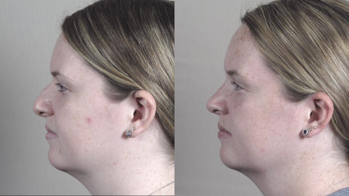 Rhinoplasty Case 1445 Before & After Left Side | Paramus, New Jersey | Parker Center for Plastic Surgery