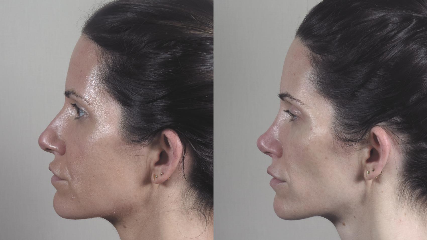 Rhinoplasty Case 1446 Before & After Left Side | Paramus, New Jersey | Parker Center for Plastic Surgery