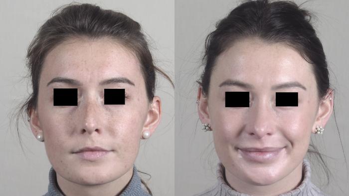 Rhinoplasty Case 1447 Before & After Front | Paramus, New Jersey | Parker Center for Plastic Surgery