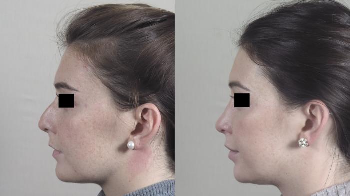 Rhinoplasty Case 1447 Before & After Left Side | Paramus, New Jersey | Parker Center for Plastic Surgery