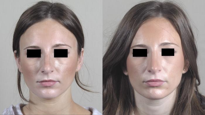 Rhinoplasty Case 1448 Before & After Front | Paramus, New Jersey | Parker Center for Plastic Surgery