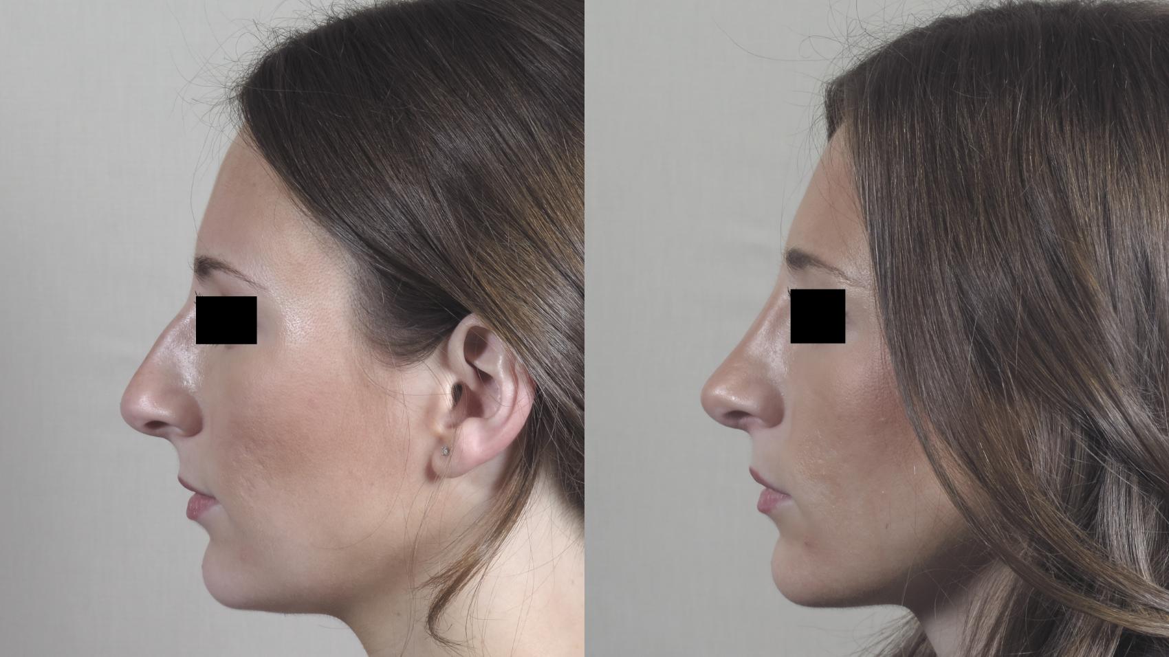 Rhinoplasty Case 1448 Before & After Left Side | Paramus, New Jersey | Parker Center for Plastic Surgery