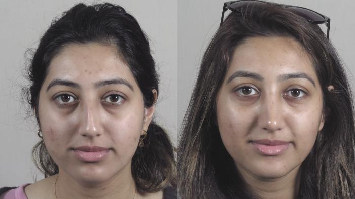 Rhinoplasty Case 1449 Before & After Front | Paramus, New Jersey | Parker Center for Plastic Surgery