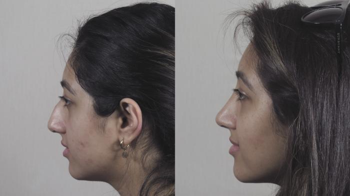 Rhinoplasty Case 1449 Before & After Left Side | Paramus, New Jersey | Parker Center for Plastic Surgery