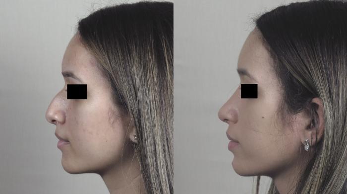 Rhinoplasty Case 1450 Before & After Left Side | Paramus, New Jersey | Parker Center for Plastic Surgery