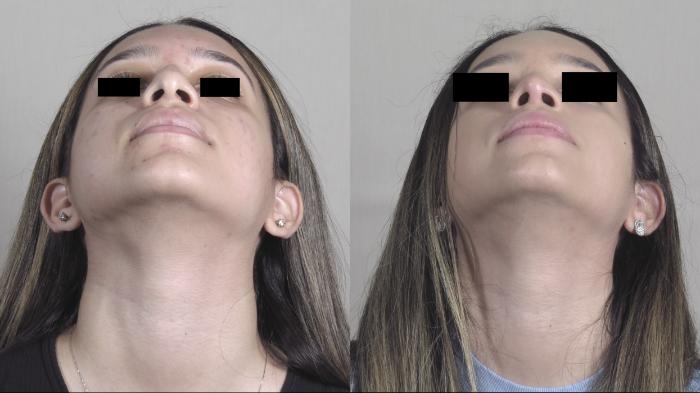 Rhinoplasty Case 1450 Before & After Worm's | Paramus, New Jersey | Parker Center for Plastic Surgery