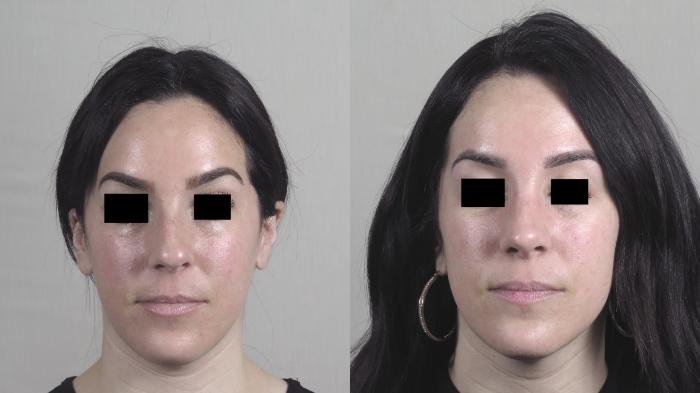 Rhinoplasty Case 1451 Before & After Front | Paramus, New Jersey | Parker Center for Plastic Surgery