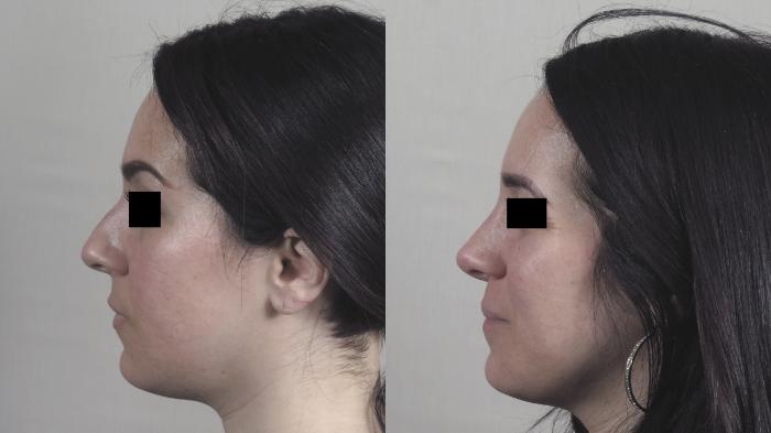 Rhinoplasty Case 1451 Before & After Left Side | Paramus, New Jersey | Parker Center for Plastic Surgery