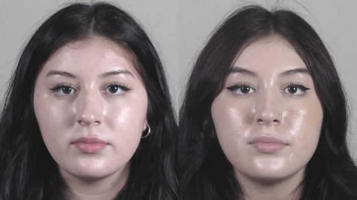 Rhinoplasty Case 1453 Before & After Front | Paramus, New Jersey | Parker Center for Plastic Surgery