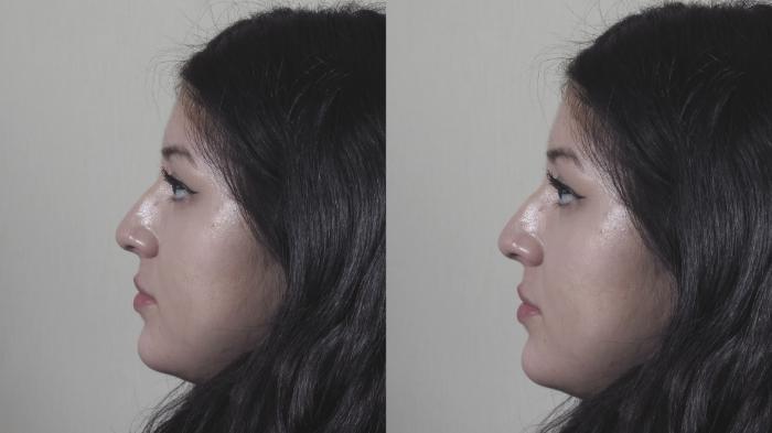 Rhinoplasty Case 1453 Before & After Left Side | Paramus, New Jersey | Parker Center for Plastic Surgery