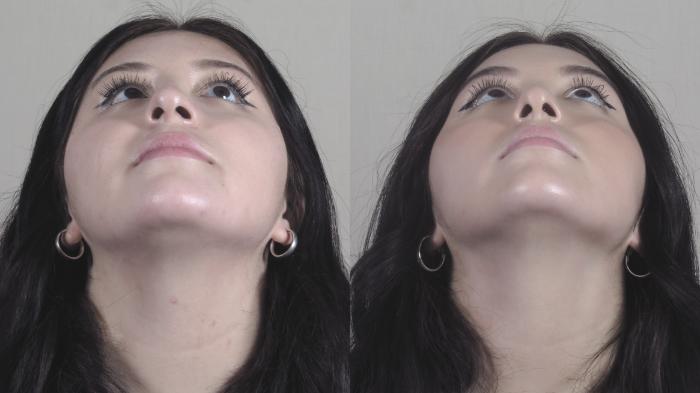 Rhinoplasty Case 1453 Before & After Worm's | Paramus, New Jersey | Parker Center for Plastic Surgery