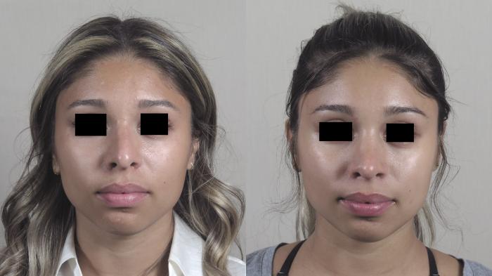 Rhinoplasty Case 1454 Before & After Front | Paramus, New Jersey | Parker Center for Plastic Surgery