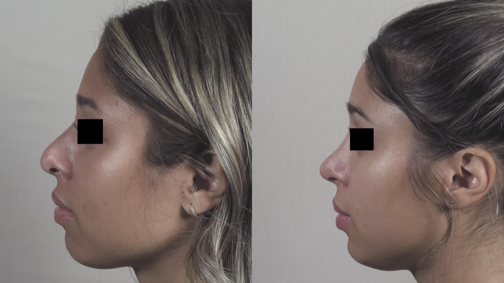 Rhinoplasty Case 1454 Before & After Left Side | Paramus, New Jersey | Parker Center for Plastic Surgery