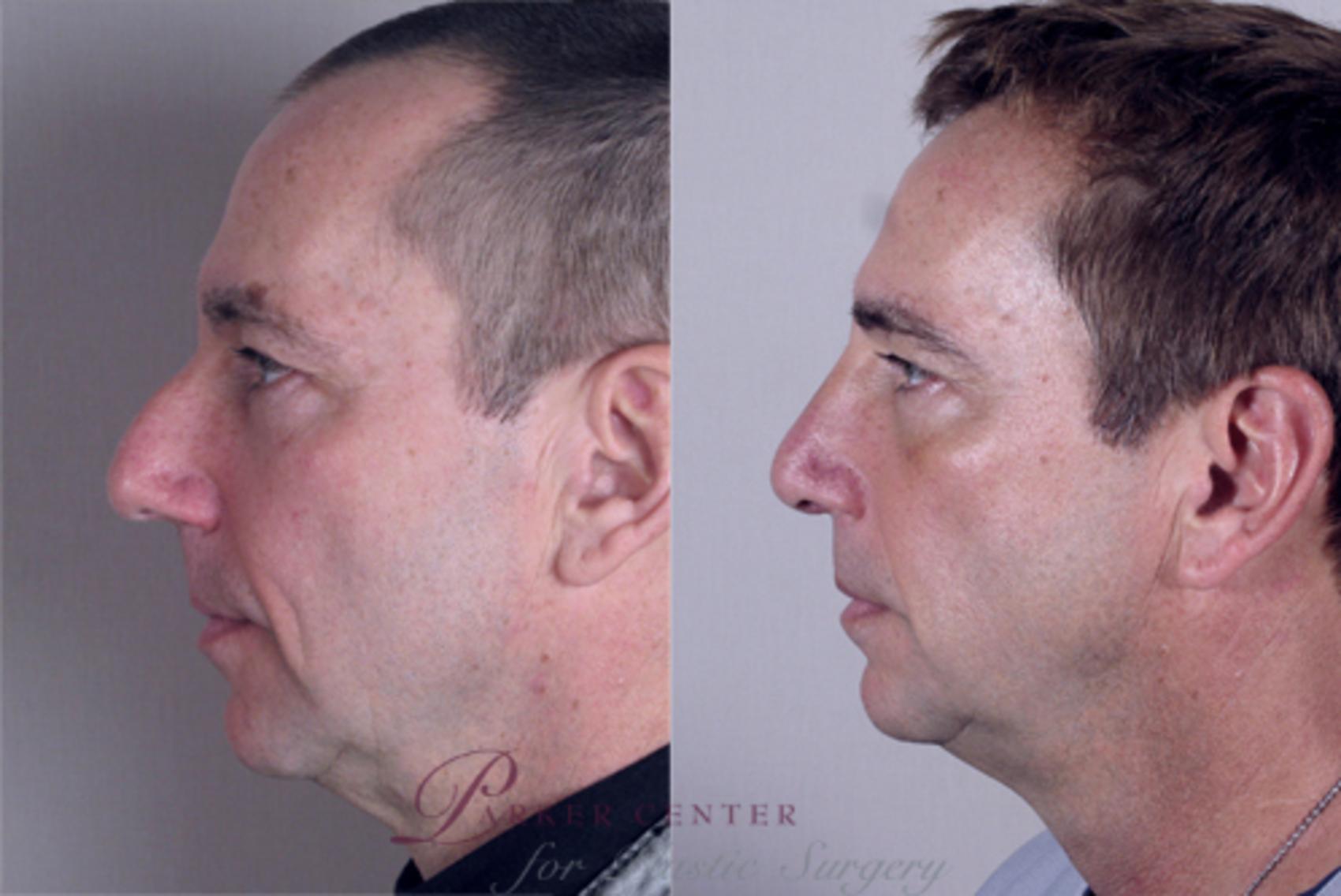 Rhinoplasty Case 146 Before & After View #2 | Paramus, NJ | Parker Center for Plastic Surgery